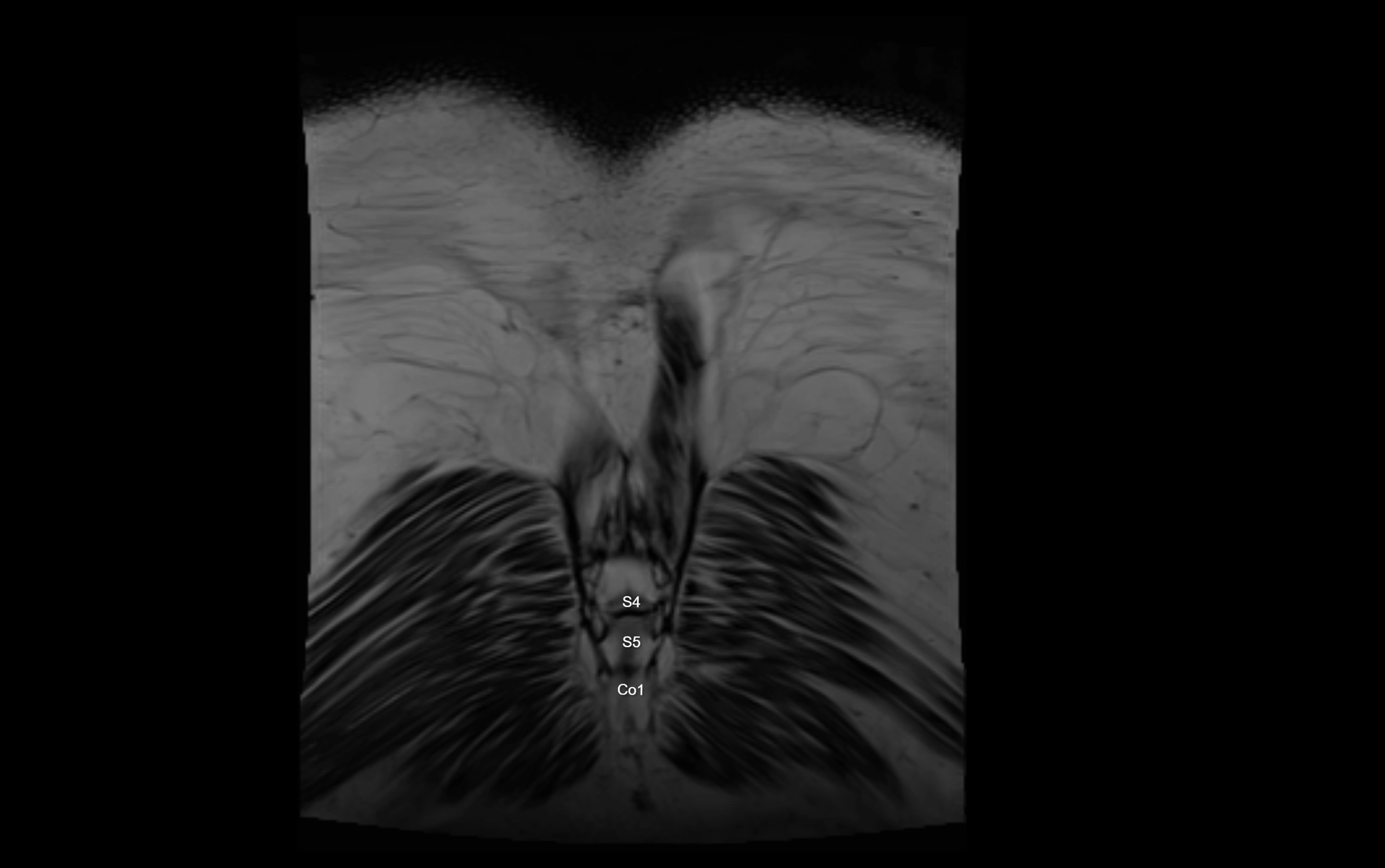 MR lumbosacral plexus cross sectional anatomy 3T  radiology  image-img-09001-00086.webp